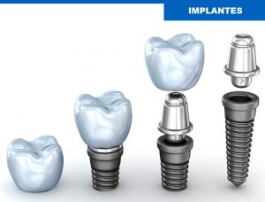 Implantes dentales